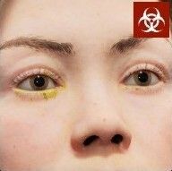 目の膿