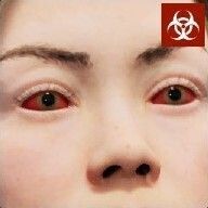 目の充血